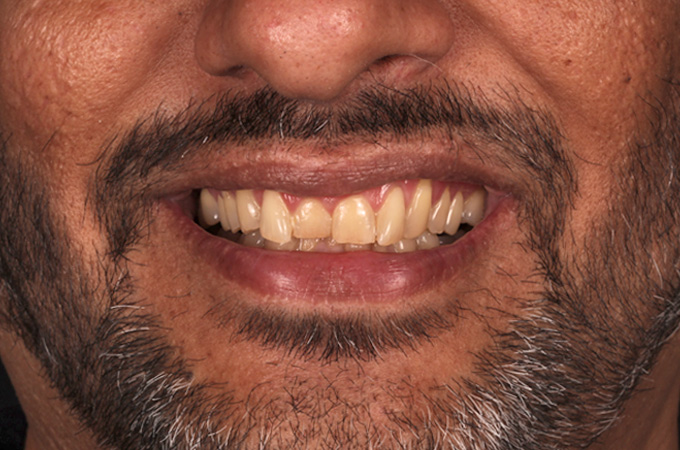 Ceramic-Veneers-Before