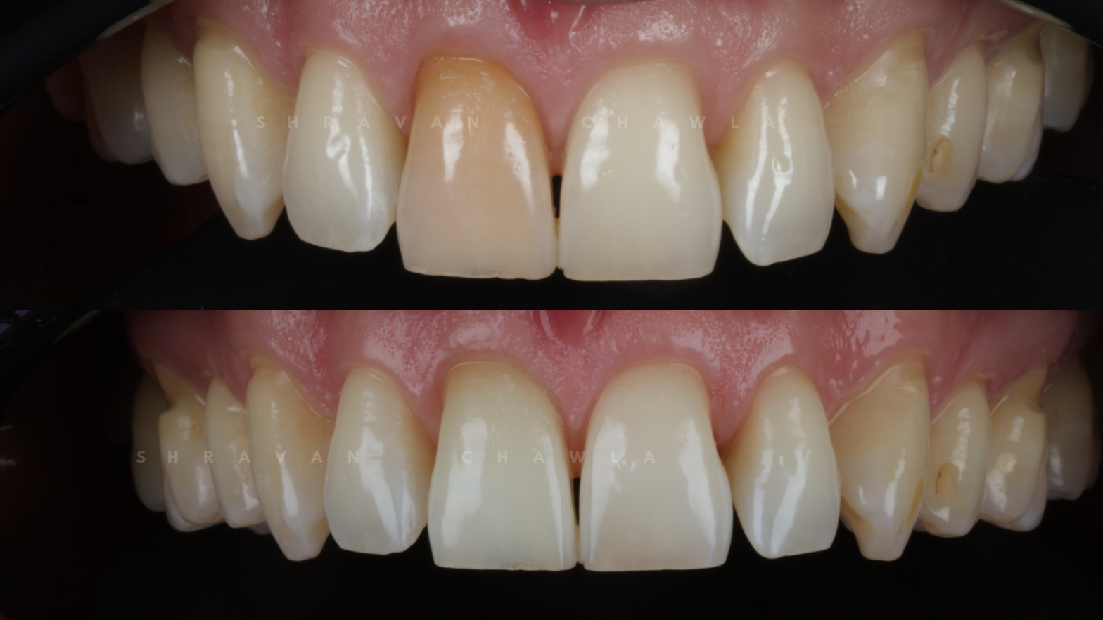 Internal Teeth whitening