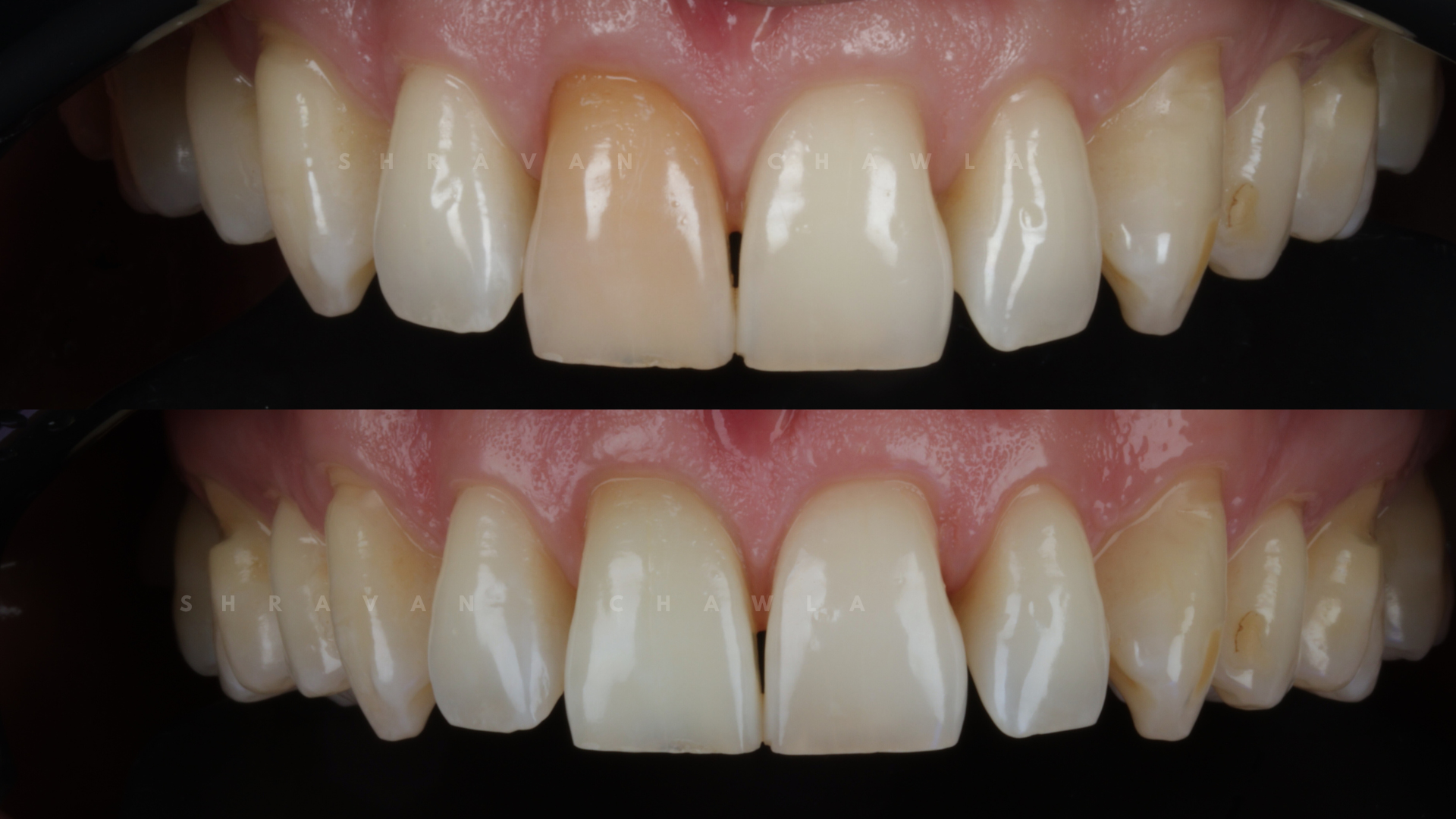 3 Internal Teeth whitening