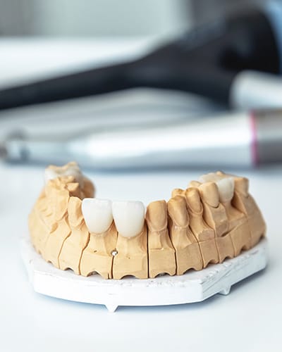 Ceramic-Veneers