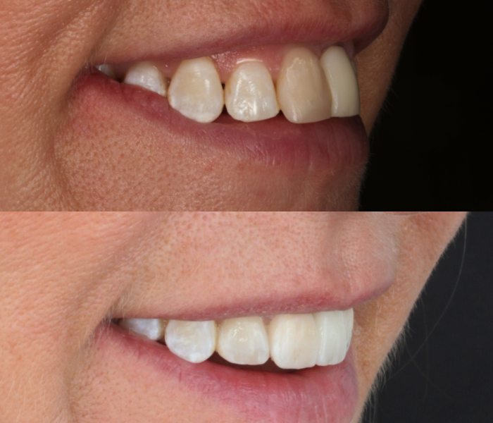 Ceramic Veneers (1)