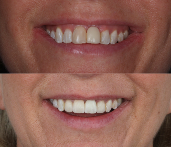 Ceramic Veneers (3)