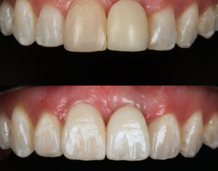 Ceramic Veneers (4)