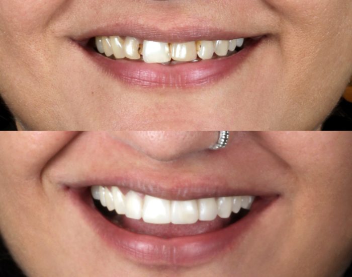 Ceramic Veneers Before-After Result