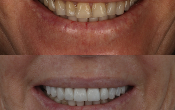 Natural Ceramic Veneers (4)