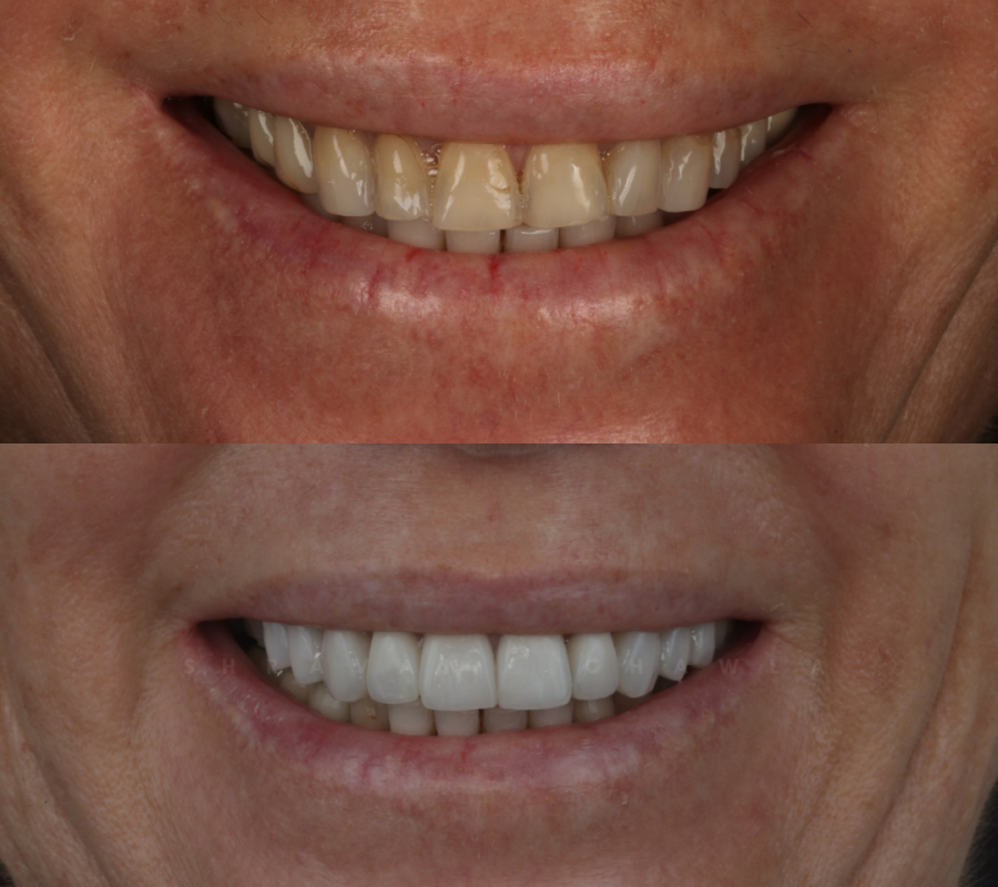 Natural Ceramic Veneers (4)