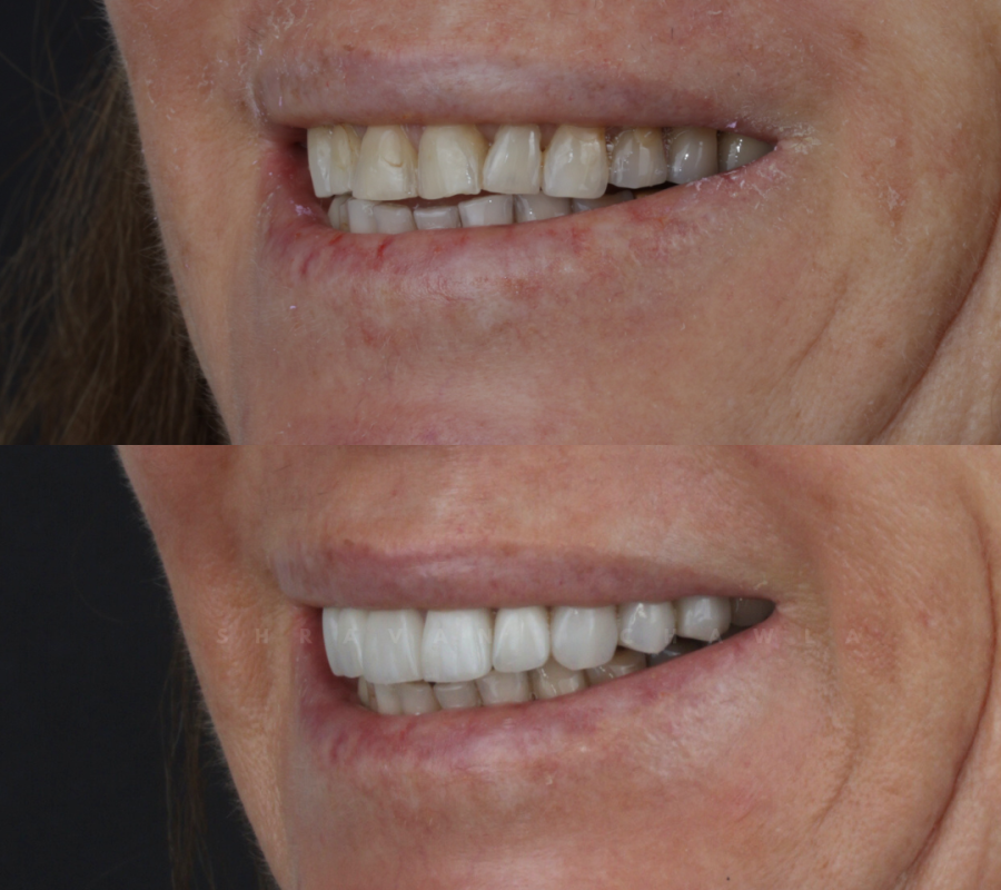 Natural Ceramic Veneers (5)