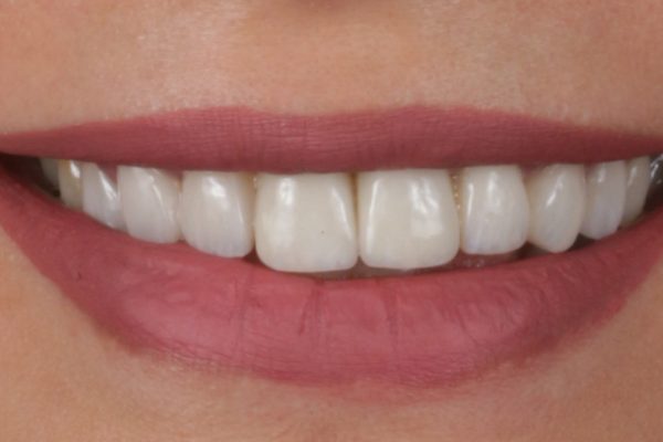 Porcelain-Veneers-1