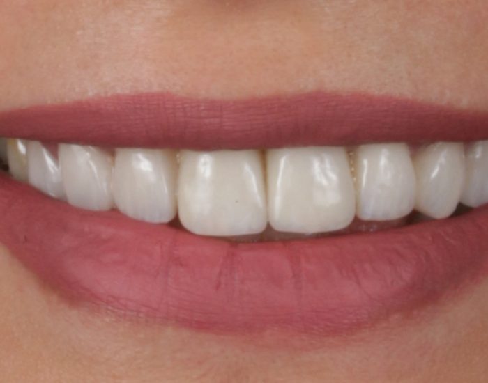 Porcelain-Veneers-1