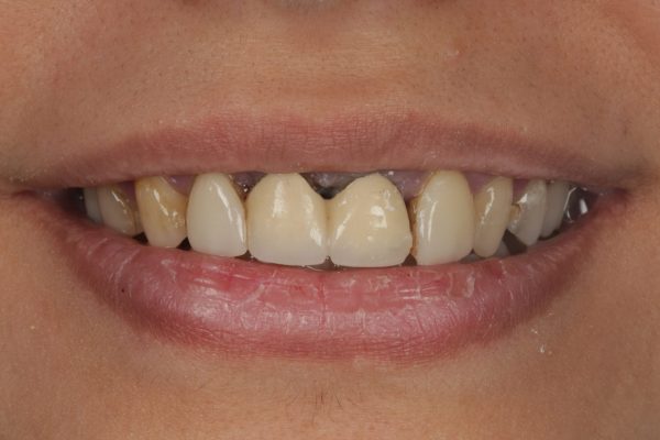 Porcelain Veneers (11)