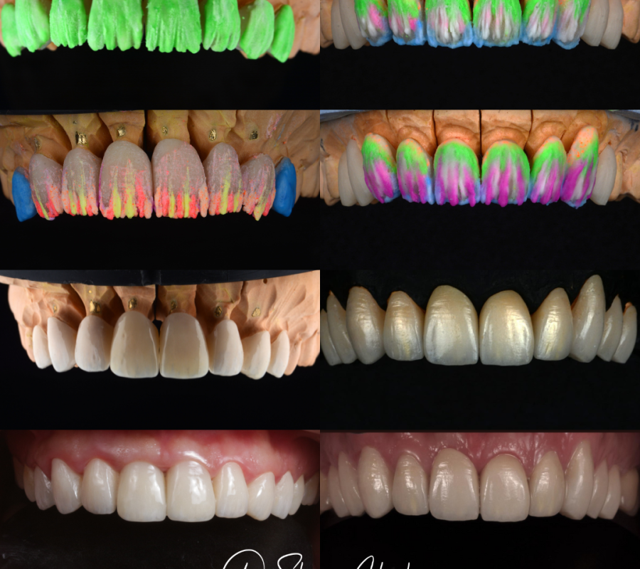 Porcelain Veneers (2)