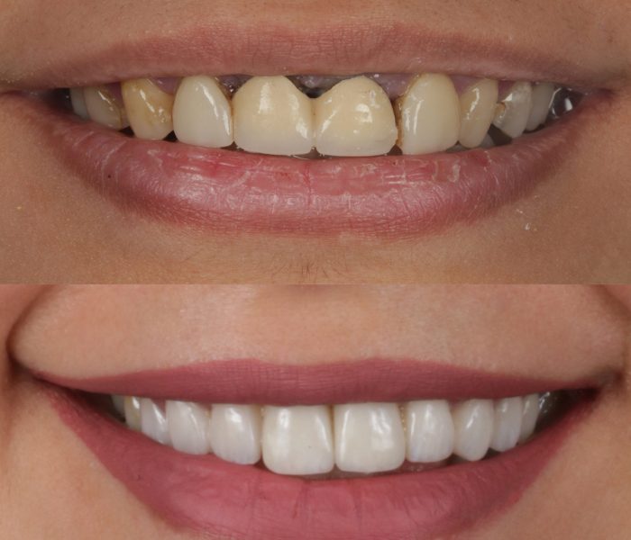 Porcelain-Veneers-3