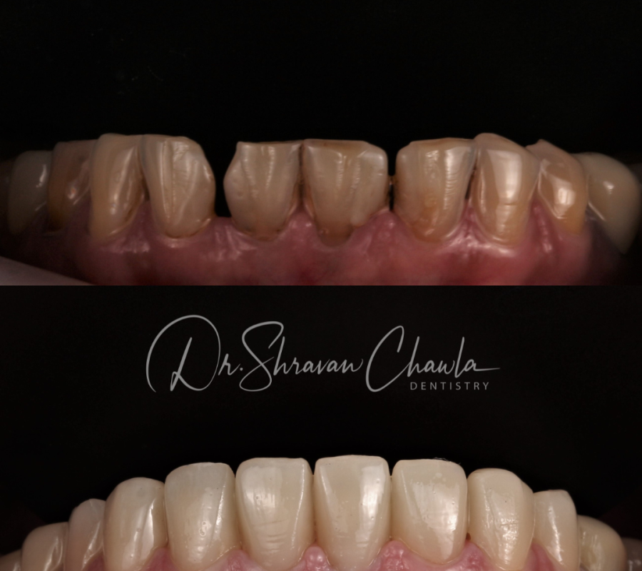 Porcelain Veneers (3)