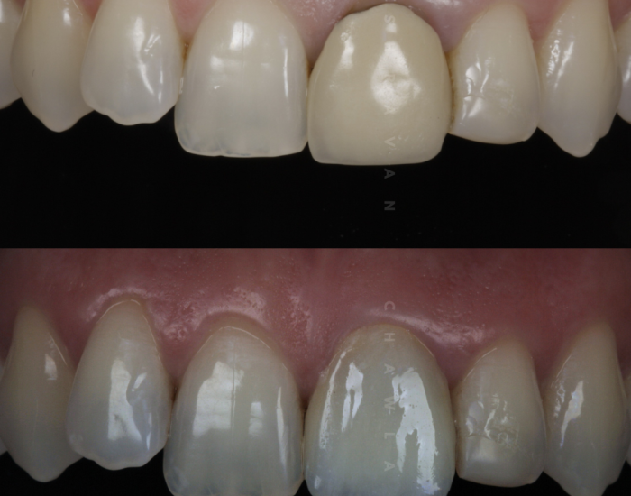 Veneer Repair