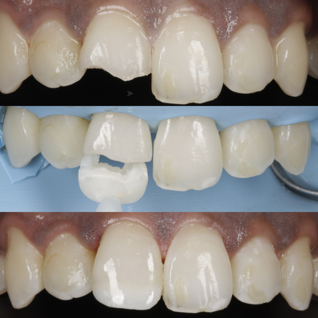 Veneer Repair