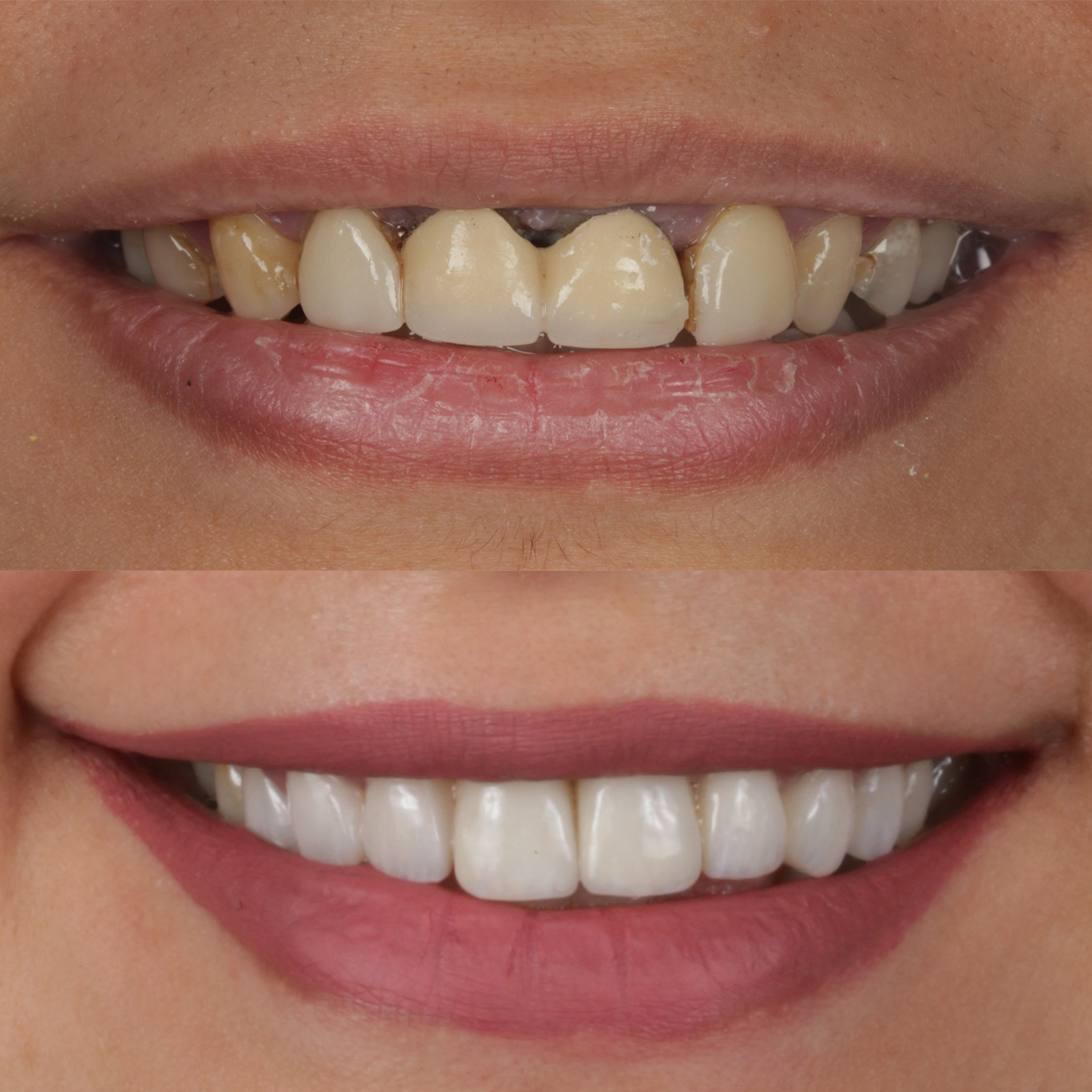 porcelain veneers dentist london