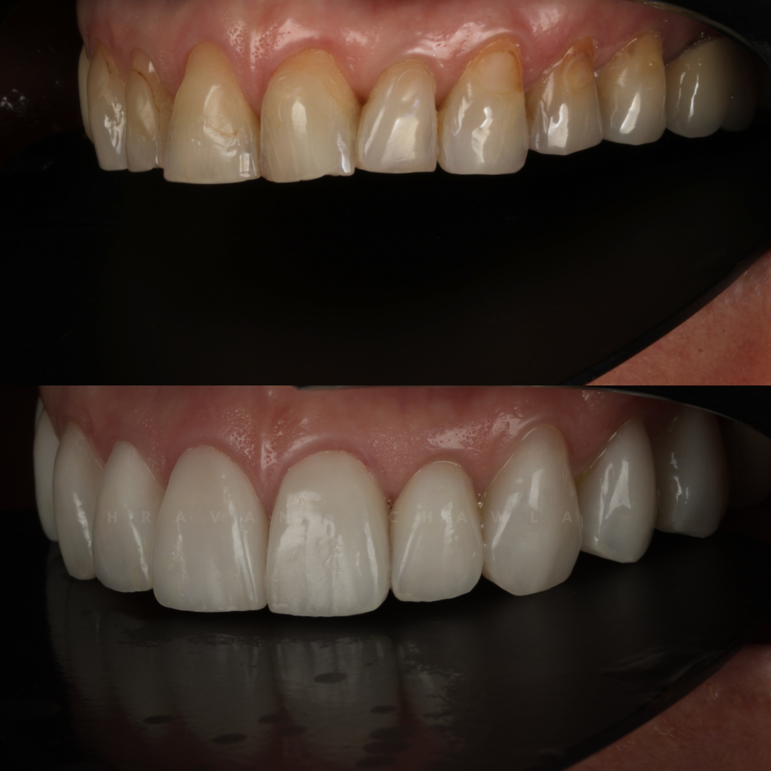 best porcelain veneers