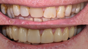 porcelain veneers dentist