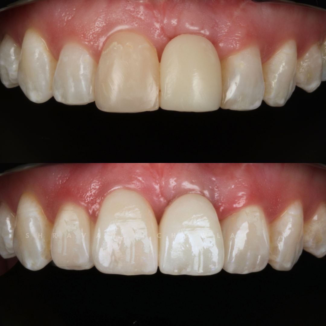 porcelain veneers dentist London