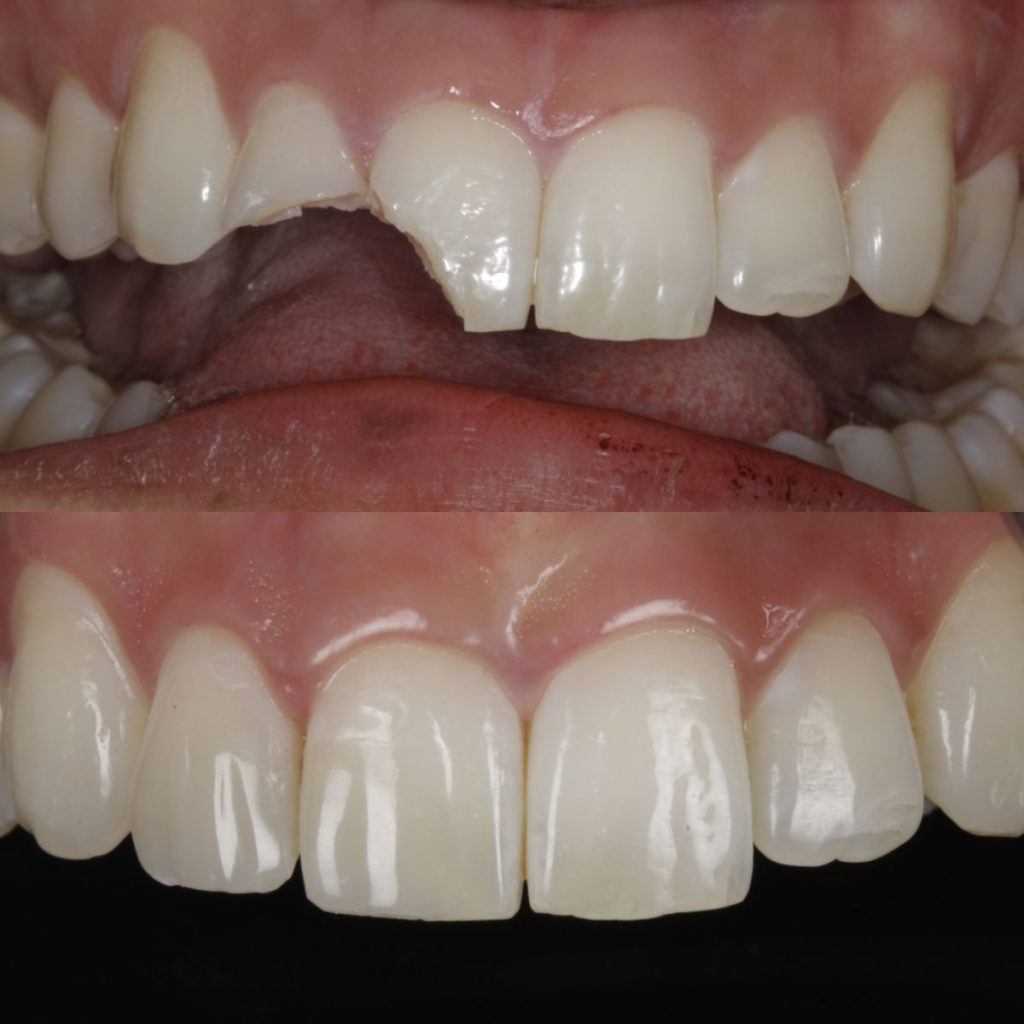 Emergency Dental Veneer Repair: How Dentists Fix Broken Veneers