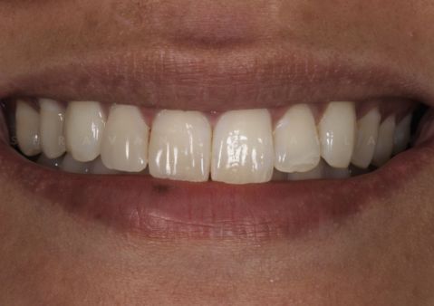 Emergency Dental Veneer 