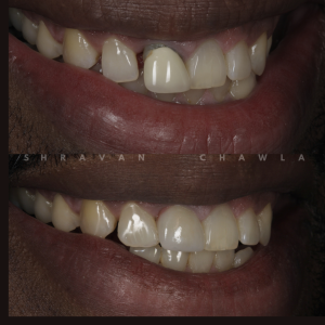 Dental Veneer Repairs