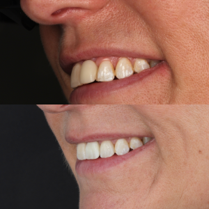 full smile makeover