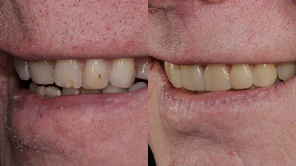 How Can a Smile Makeover Dentist London Boost Your Confidence and Oral Health?