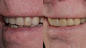 Smile Makeover Dentist London1