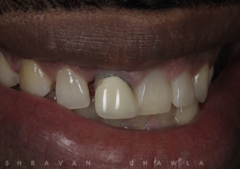 Our Client Journeys and Stories of Our Dental Veneer Repair London Services