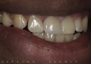 emergency dental veneer repairs