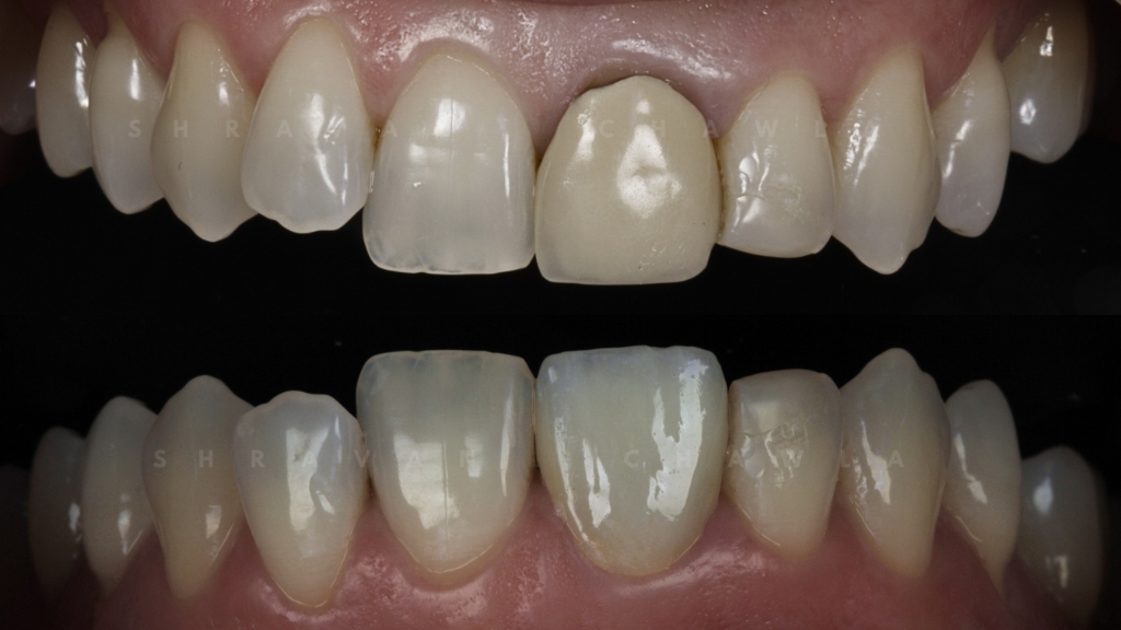 Importance of Aesthetic Natural Ceramic Veneers in Cosmetic Dental Work