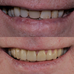 natural dental veneers1