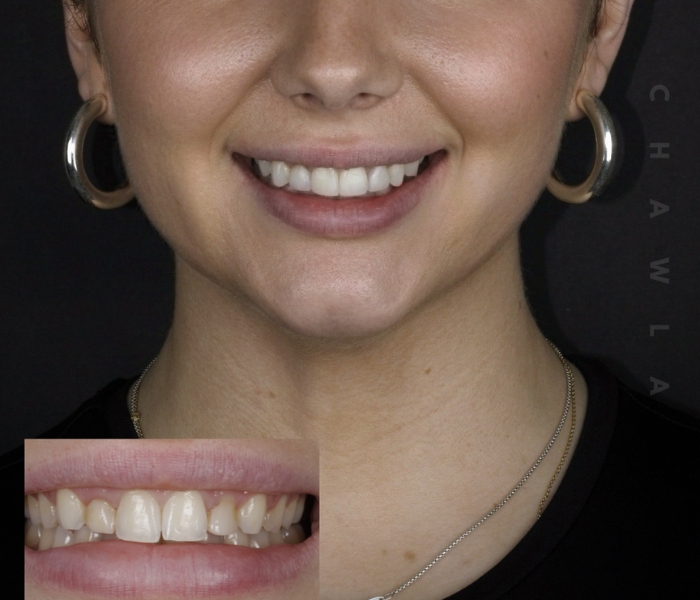 The Ultimate Guide to Dental Crowns: Restore Your Smile with Confidence