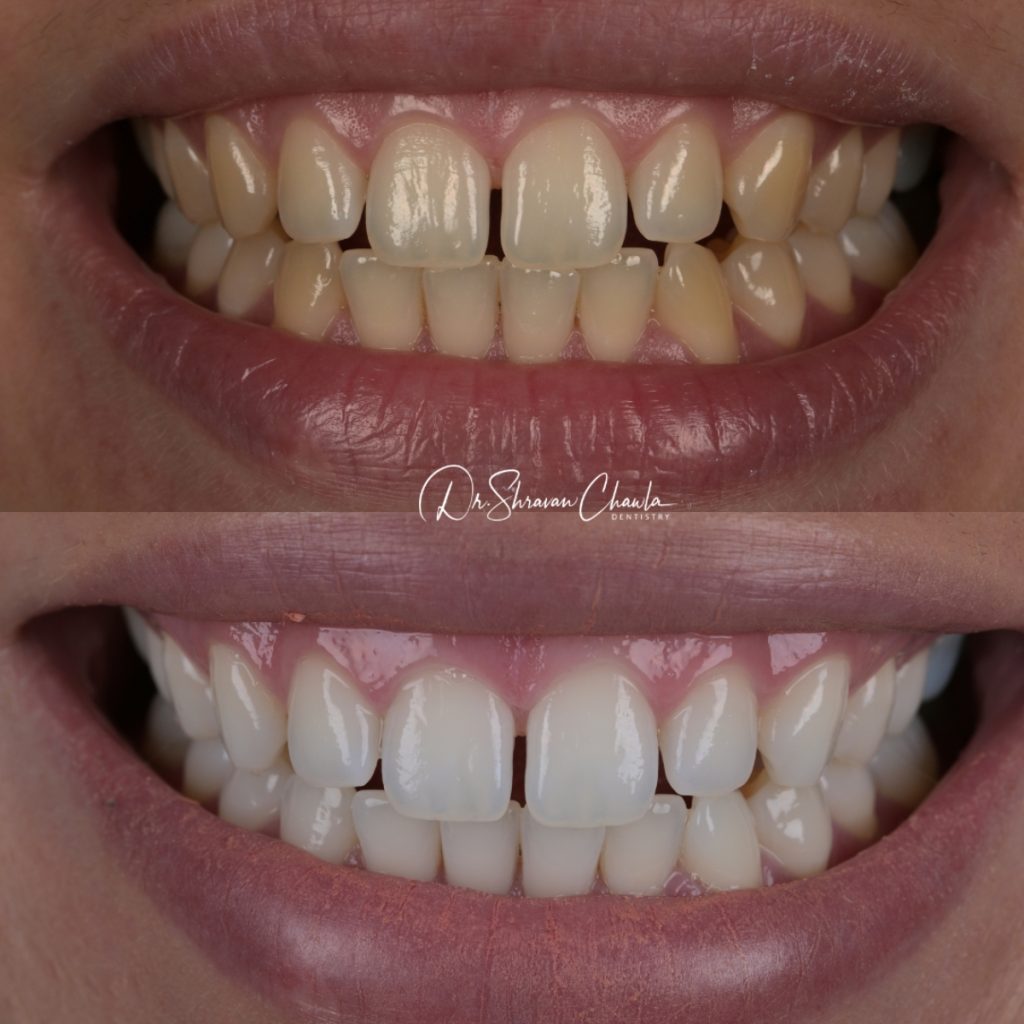 Composite Bonding – What Is It And Why Is It Important In Cosmetic Dentistry