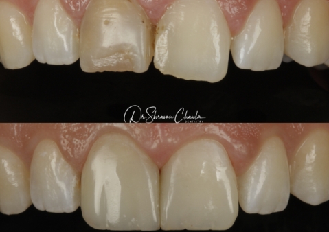 How Smile Trends Have Shaped Modern Porcelain Veneers Dentist London?