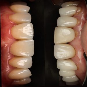 Modern Porcelain Veneers Dentist