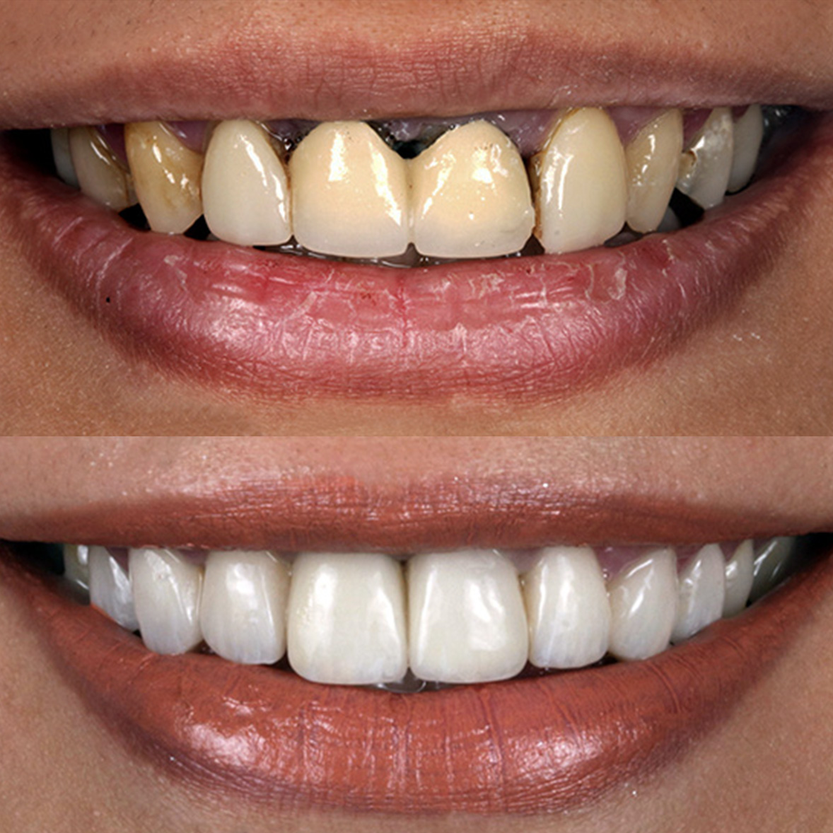 Ceramic Veneer