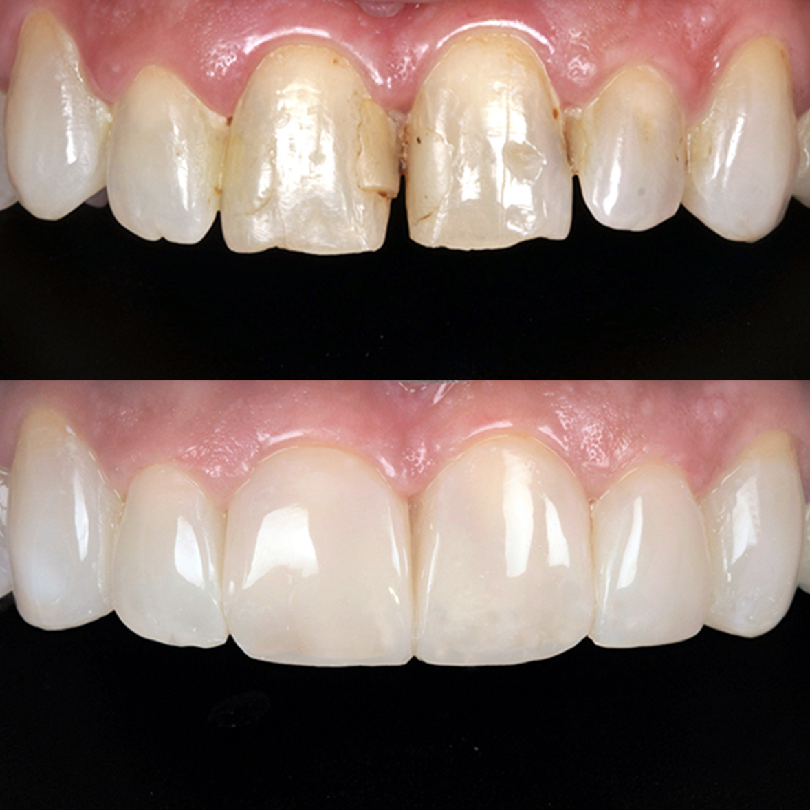 Composite Bonding