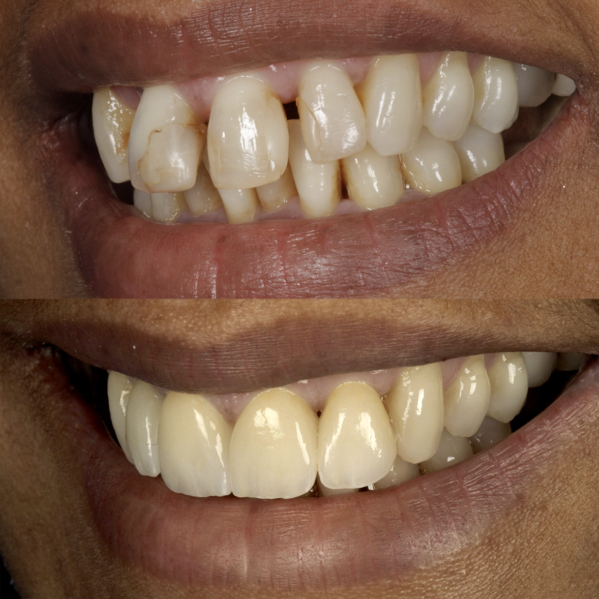 Our Services - Ceramic Porcelain Veneer