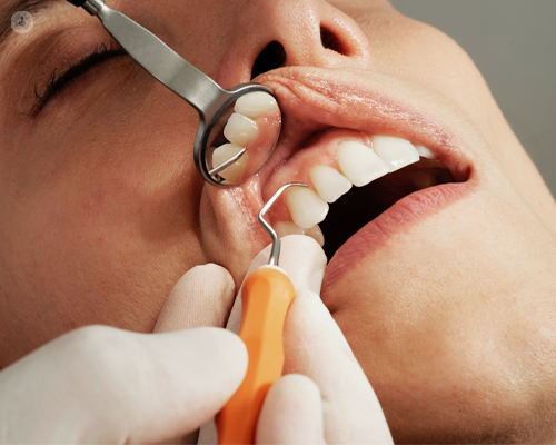 How long does composite bonding last?